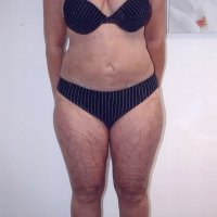 Liposculpture 015