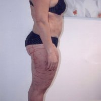 Liposculpture 015