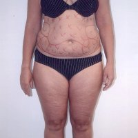 Liposculpture 015