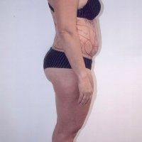 Liposculpture 015