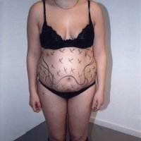 Liposculpture 006