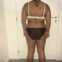 Liposculpture 009