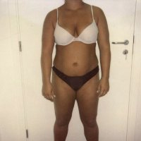 Liposculpture 009