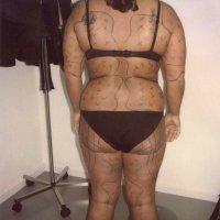 Liposculpture 009