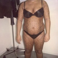 Liposculpture 009