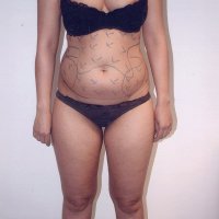 Liposculpture 011
