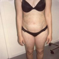 Liposculpture 008
