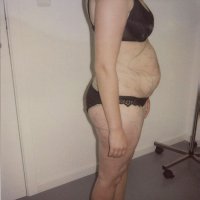 Liposculpture 008