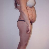 Liposculpture 013