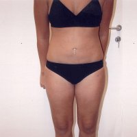 Liposculpture 010