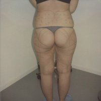 Liposculpture 010