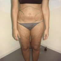 Liposculpture 010