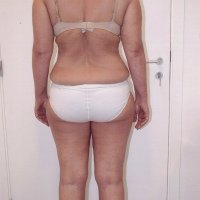 Liposculpture 014