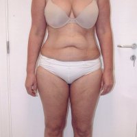 Liposculpture 014