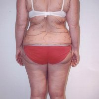 Liposculpture 014