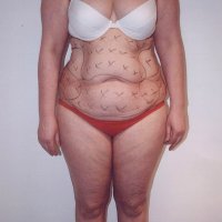 Liposculpture 014