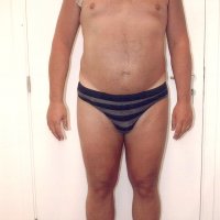 Liposculpture 012