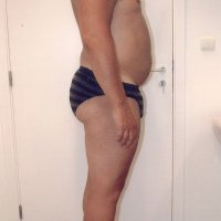 Liposculpture 012