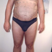 Liposculpture 012