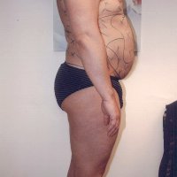 Liposculpture 012