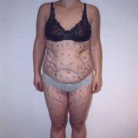 Liposculpture 007