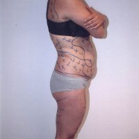 Liposculpture 007