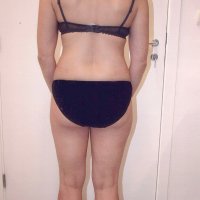 Liposculpture 016