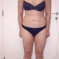 Liposculpture 016