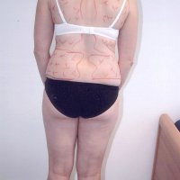 Liposculpture 016