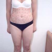 Liposculpture 016