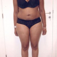 Liposculpture 017