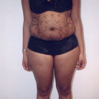Liposculpture 017