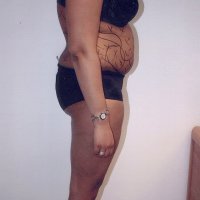 Liposculpture 017