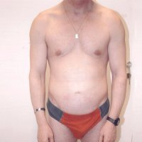 Liposculpture 010