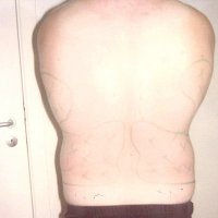 Liposculpture 010