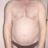 Liposculpture 010